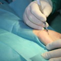cirugia de la mano y nervio periferico