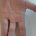 Tratamiento lesion dedos de la mano
