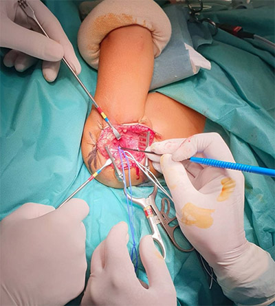 cirugia plexo braquial obsterico