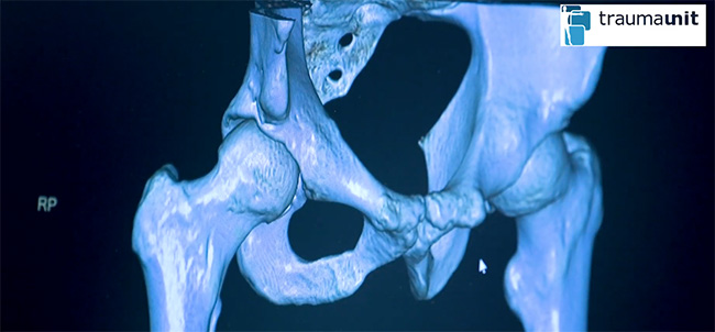 artroscopia de cadera