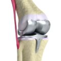 protesis-de-rodilla-imagen-en-3D