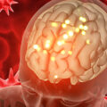 ictus y neurorrehabilitacion