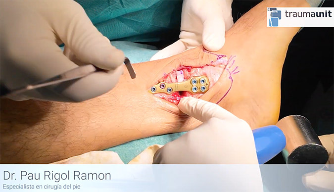 Osteotomia de tobillo en varo