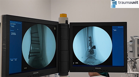 osteotomia de tobillo