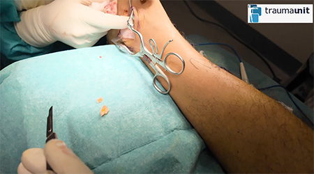 reparación ligamento osteotomia de tobillo