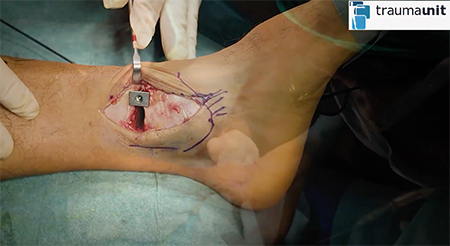 osteotomia tobillo en varo