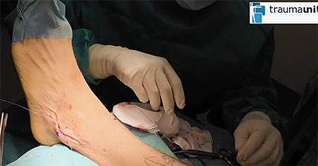 retensado ligamento tobillo