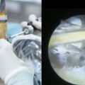 artroscopia de muñeca en Traumaunit