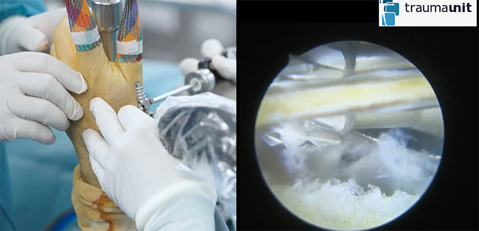 artroscopia de muñeca en Traumaunit